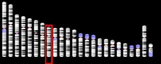 Infertility Klinefelter Syndrome