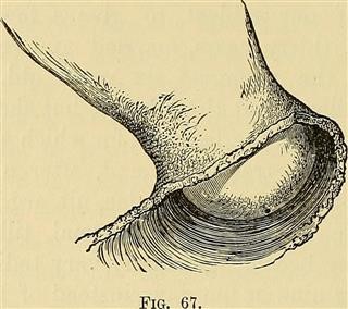 Infertility Fallopian Tube Blocked